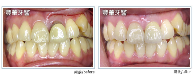 case 004 L case 004