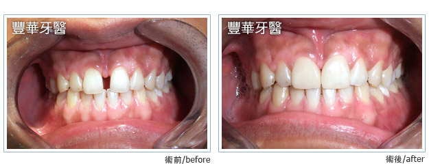 case 006 L case 006