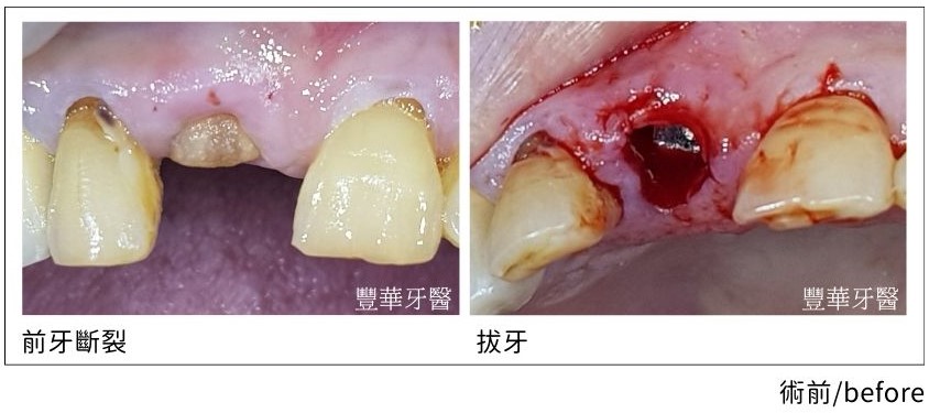 anterior tooth fracture.01