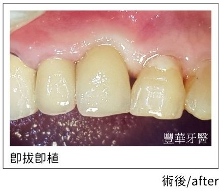 anterior tooth fracture.02