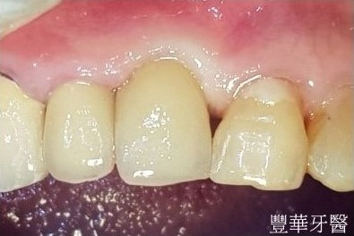 前牙斷裂即拔即植