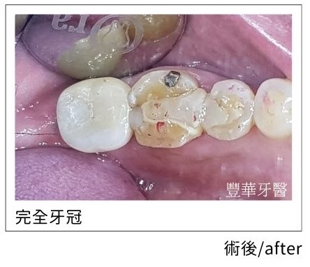 case after 1