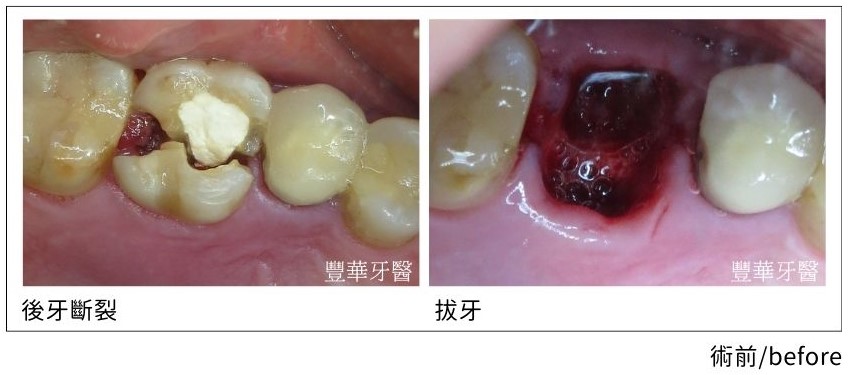 immediate implantation.01