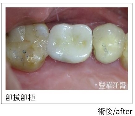 immediate implantation.02