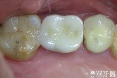 即拔即植案例