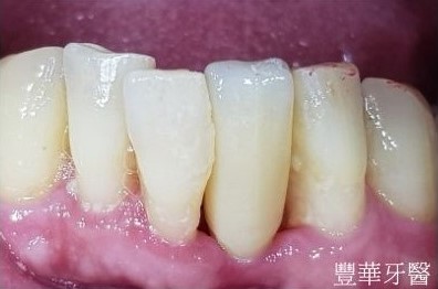 側門牙齒牙周病即拔即植