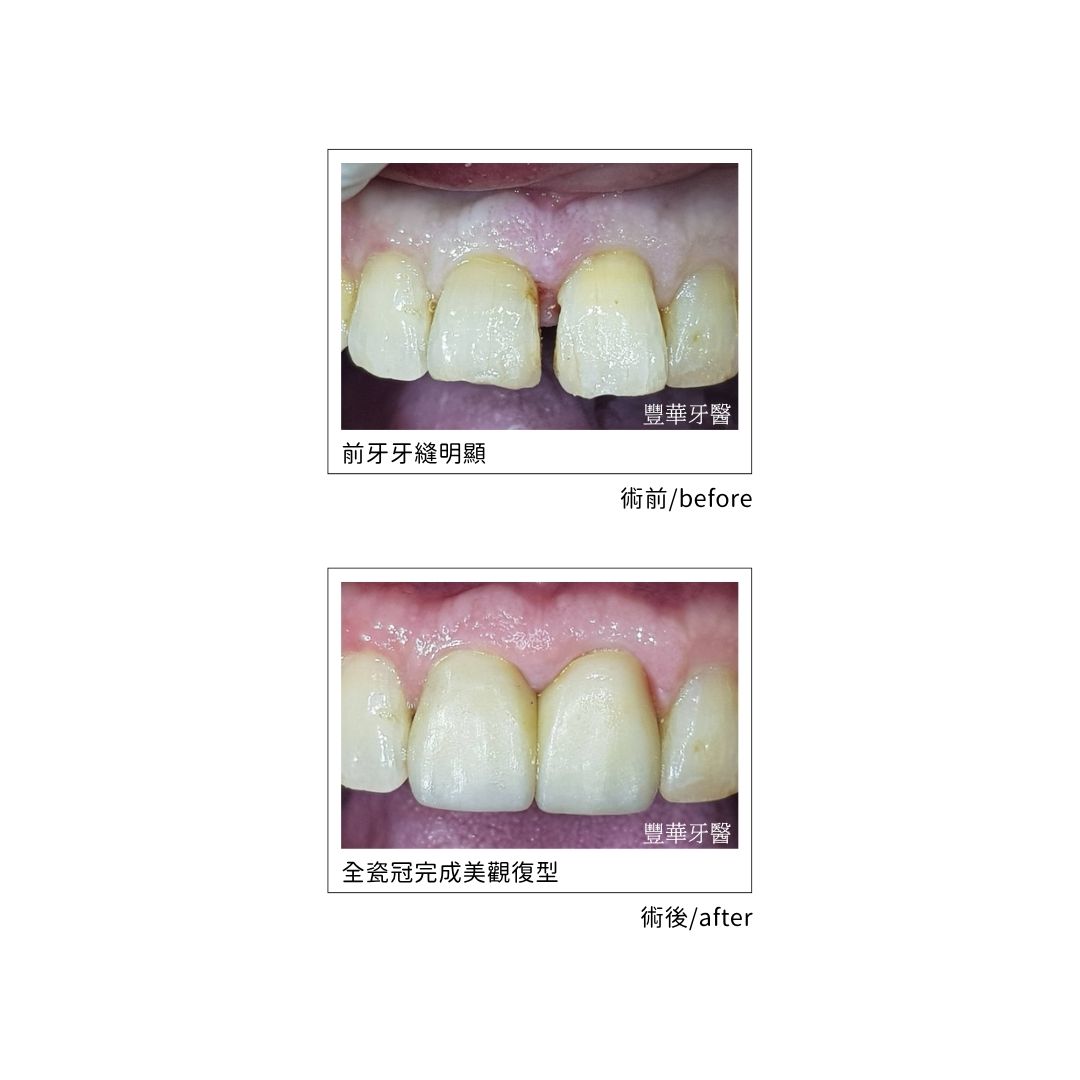 門牙全瓷冠